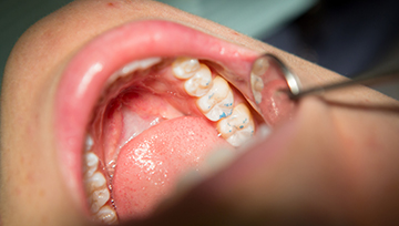 Teeth examined after filling placement
