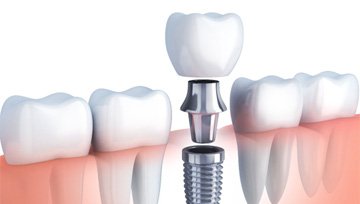 Digital illustration of a dental implant in Ann Arbor