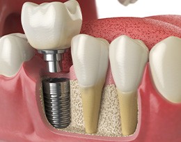 Illustration of dental implant in jawbone